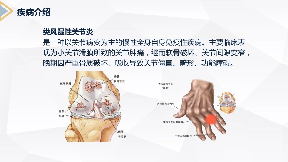 内科护理：类风湿性关节炎护理查房_第4页