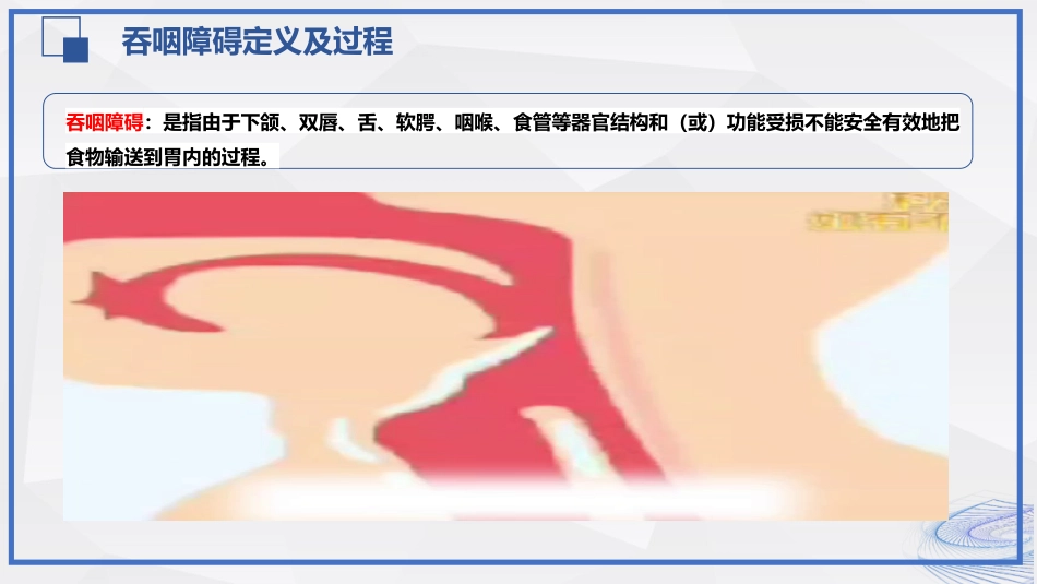 脑卒中吞咽障碍患者的评估与护理_第9页