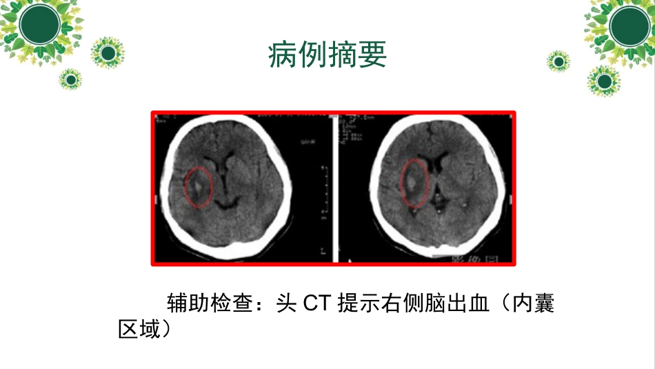 脑出血教学查房_第6页
