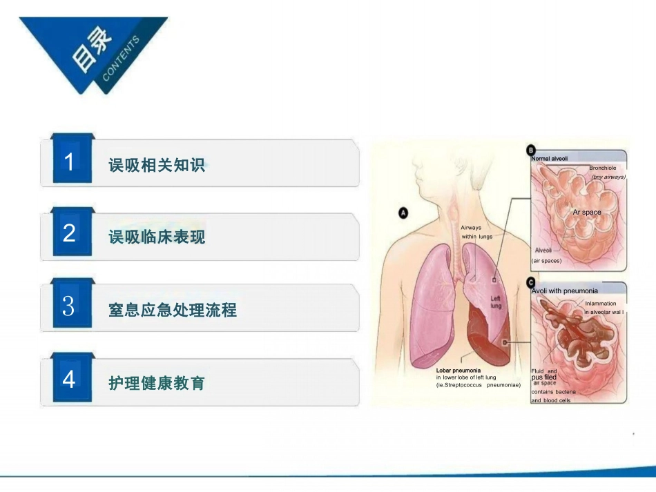 患者发生误吸的应急处理_第3页