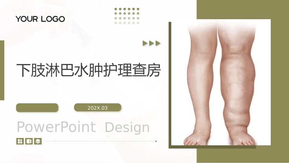 下肢淋巴水肿护理查房带参考文献_第1页