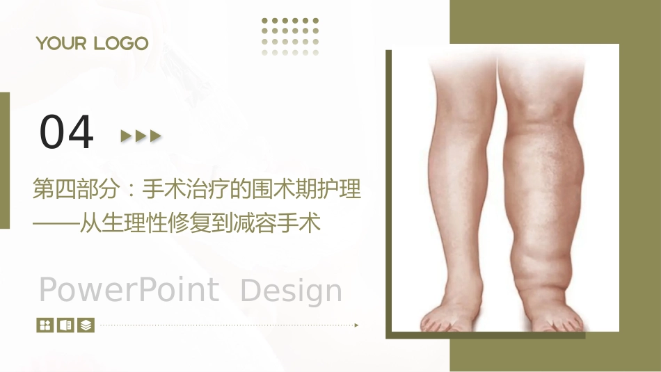 下肢淋巴水肿护理查房带参考文献_第12页