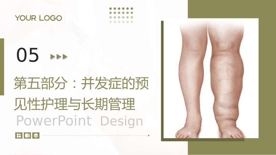 下肢淋巴水肿护理查房带参考文献_第15页