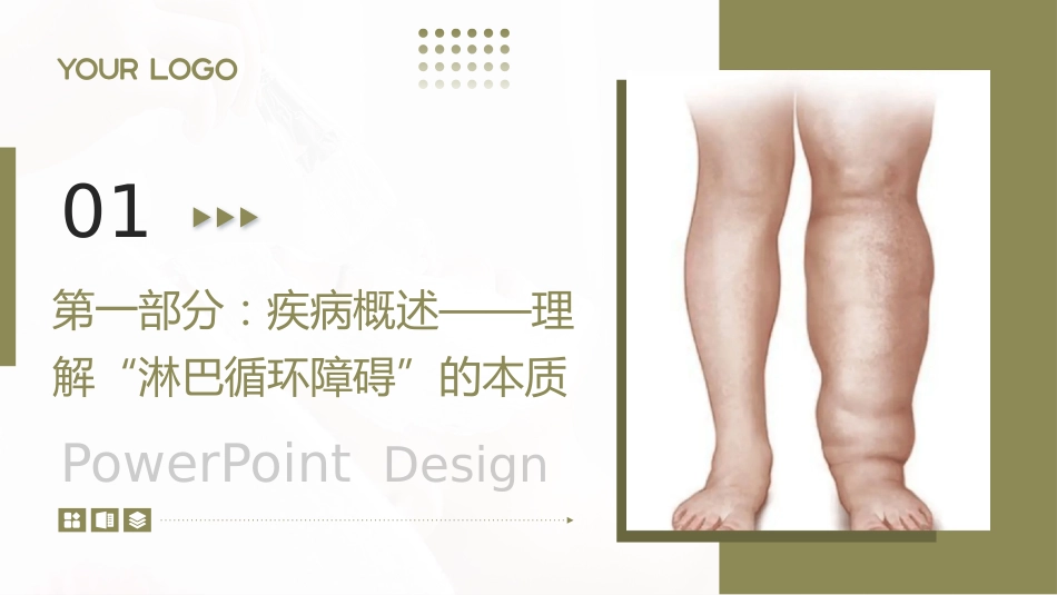 下肢淋巴水肿护理查房带参考文献_第3页