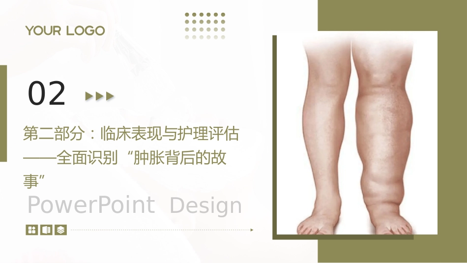 下肢淋巴水肿护理查房带参考文献_第5页