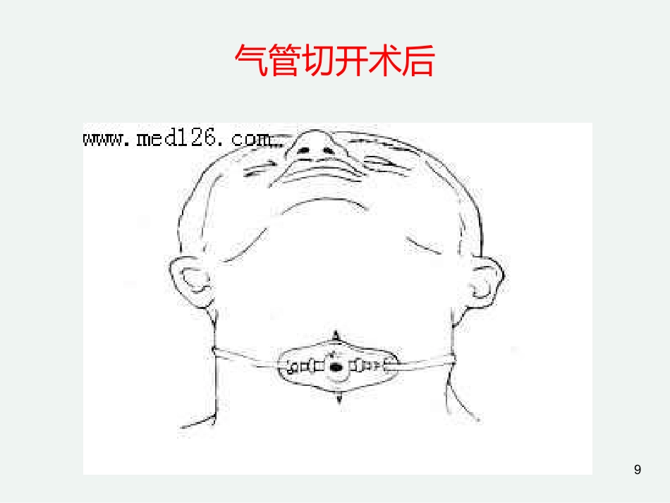 气管切开后的护理常规_第9页