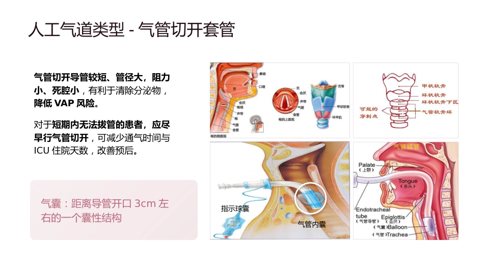 人工气道气囊的管理_第11页