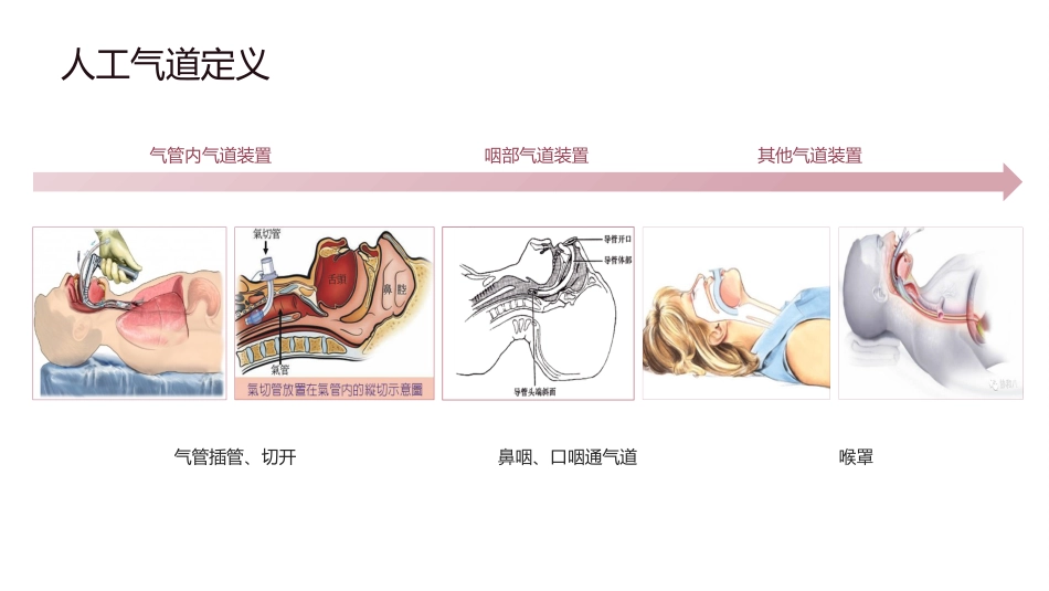 人工气道气囊的管理_第5页