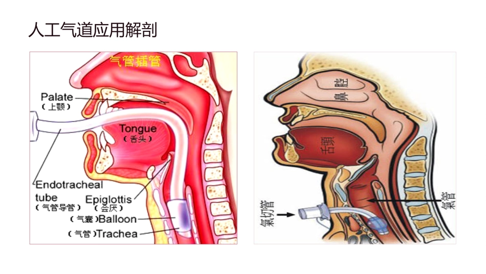 人工气道气囊的管理_第6页