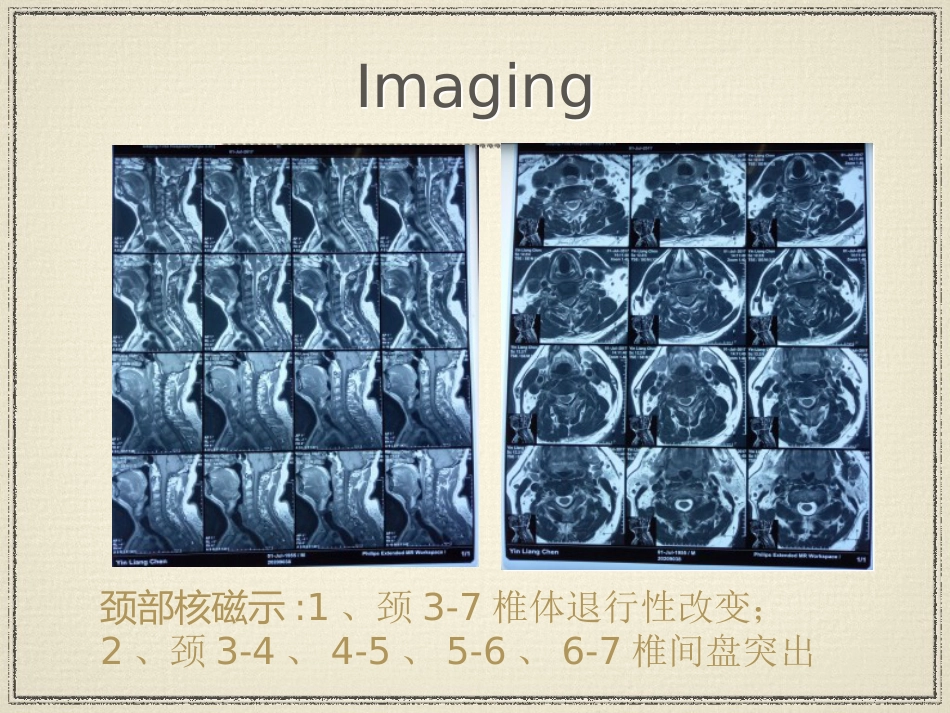 教学查房脑梗塞ppt_第12页