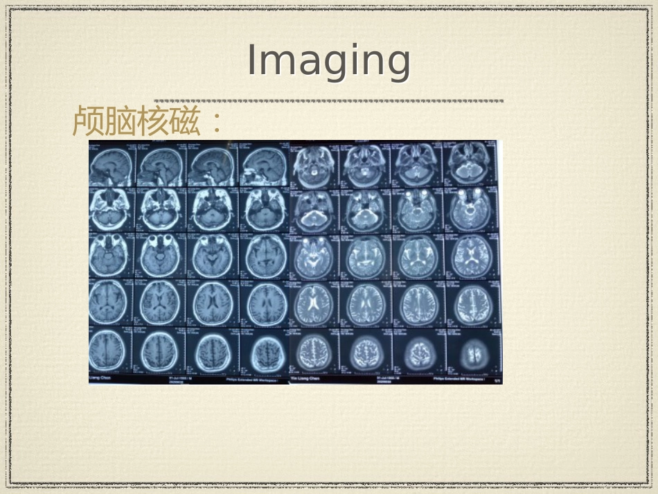 教学查房脑梗塞ppt_第13页