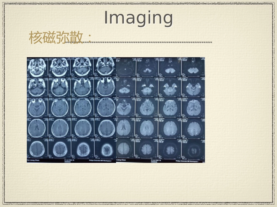 教学查房脑梗塞ppt_第14页