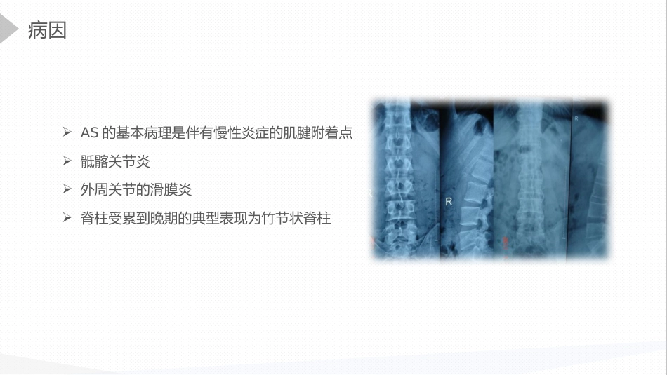 内科护理：强直性脊柱炎的护理查房_第9页