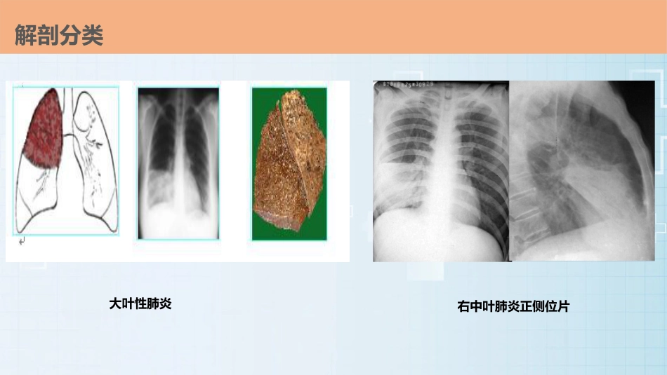 肺部感染的护理查房PPT课件_第12页