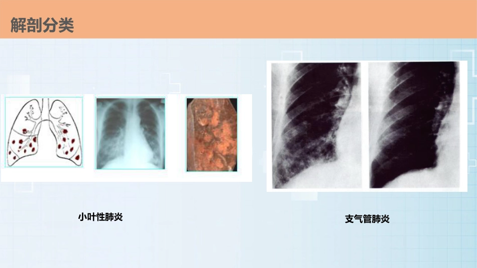 肺部感染的护理查房PPT课件_第13页
