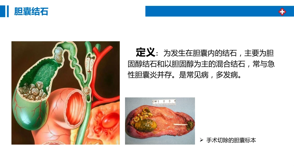 胆囊结石围手术期护理_第5页
