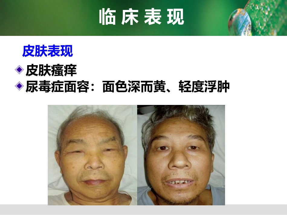 尿毒症病人的护理_第14页