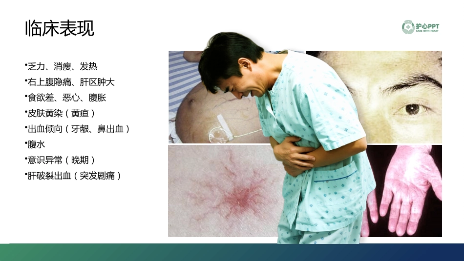 肝动脉灌注化疗（HAIC）护理美化稿_第5页