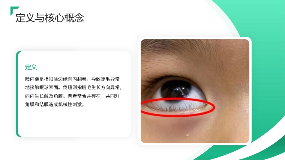 儿童睑内翻倒睫护理查房带参考文献_第4页