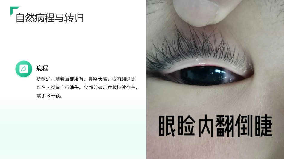 儿童睑内翻倒睫护理查房带参考文献_第7页