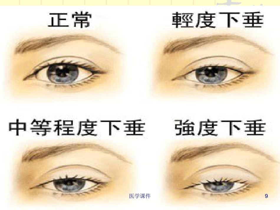 重症肌无力的护理PPT课件_第9页