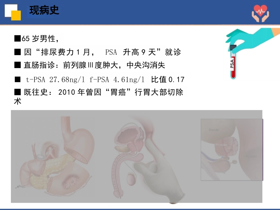 前列腺癌根治术护理查房_第13页