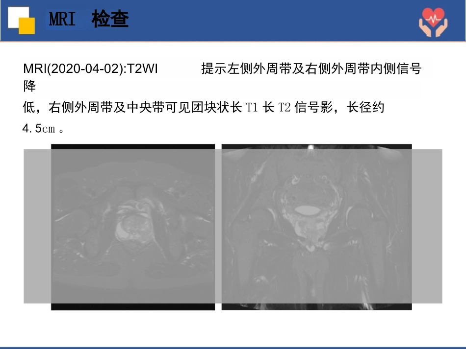 前列腺癌根治术护理查房_第14页