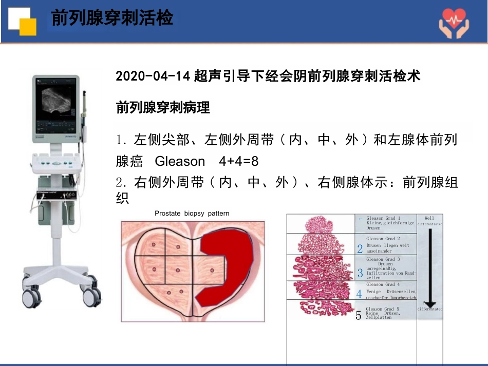 前列腺癌根治术护理查房_第15页
