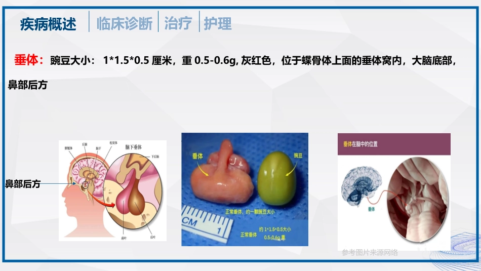 垂体瘤的治疗和护理_第3页