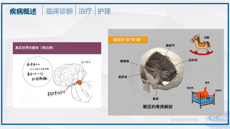垂体瘤的治疗和护理_第4页