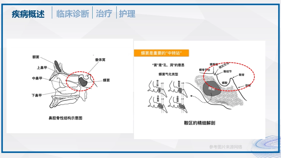 垂体瘤的治疗和护理_第7页