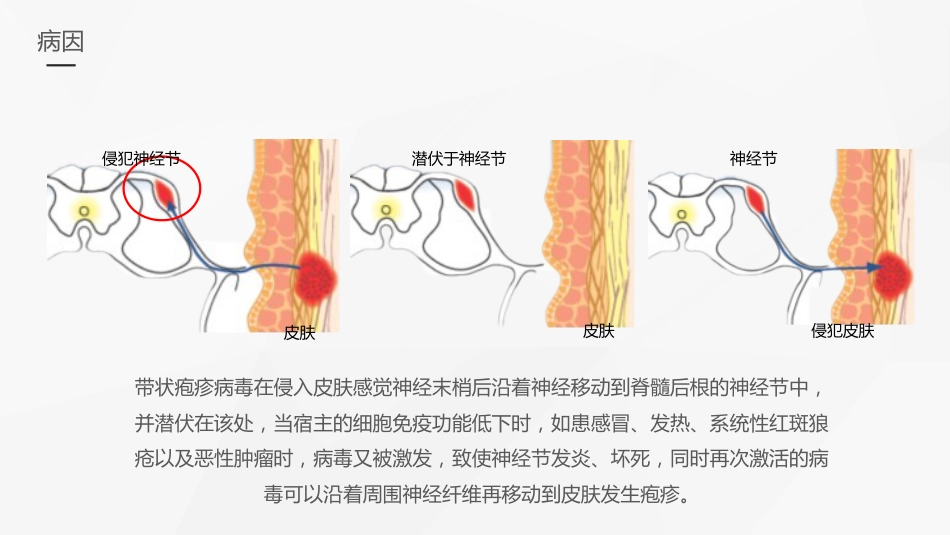 内科护理：带状疱疹后遗神经痛护理课件_第7页