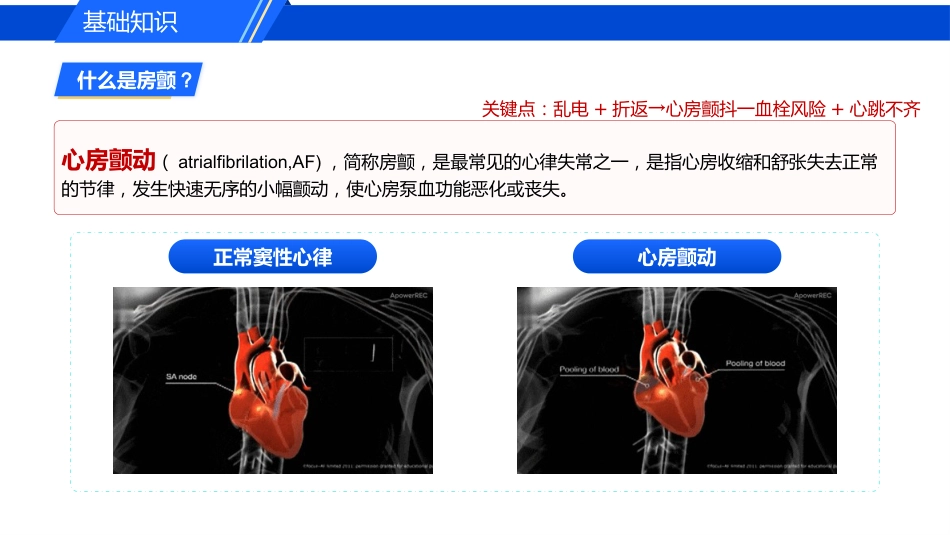 认识心房颤动_第8页