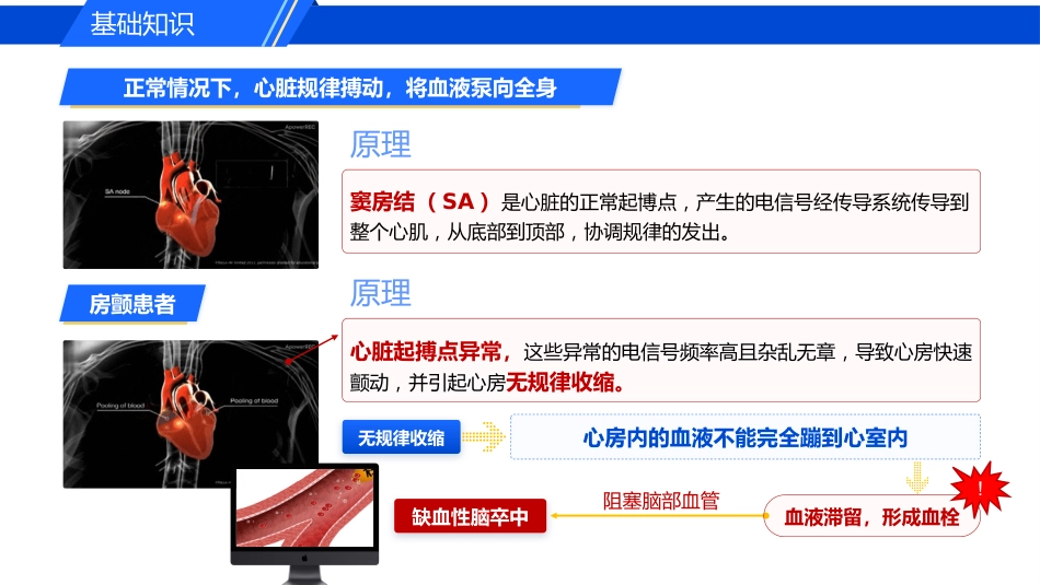 认识心房颤动_第9页
