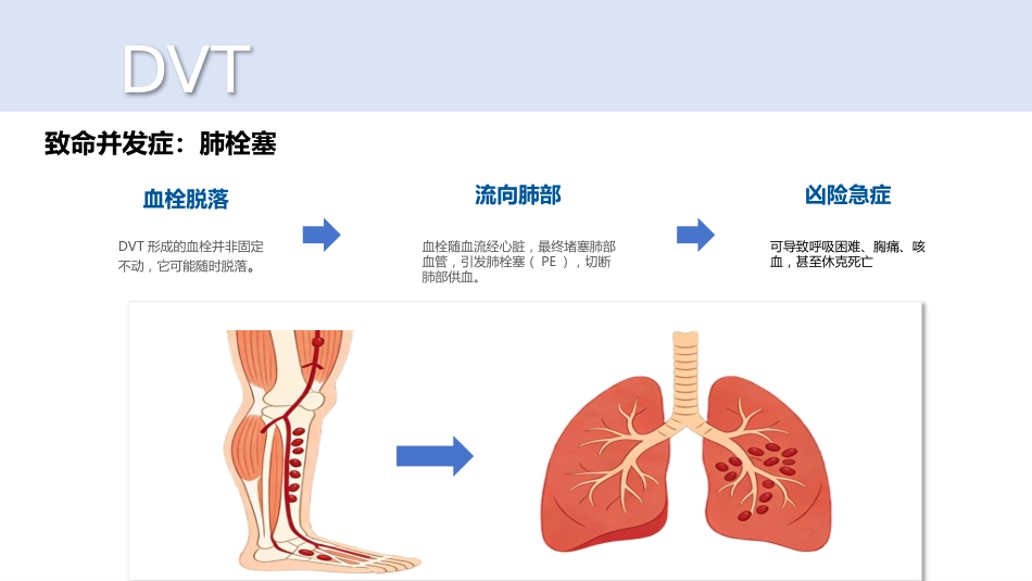 深静脉血栓_第12页