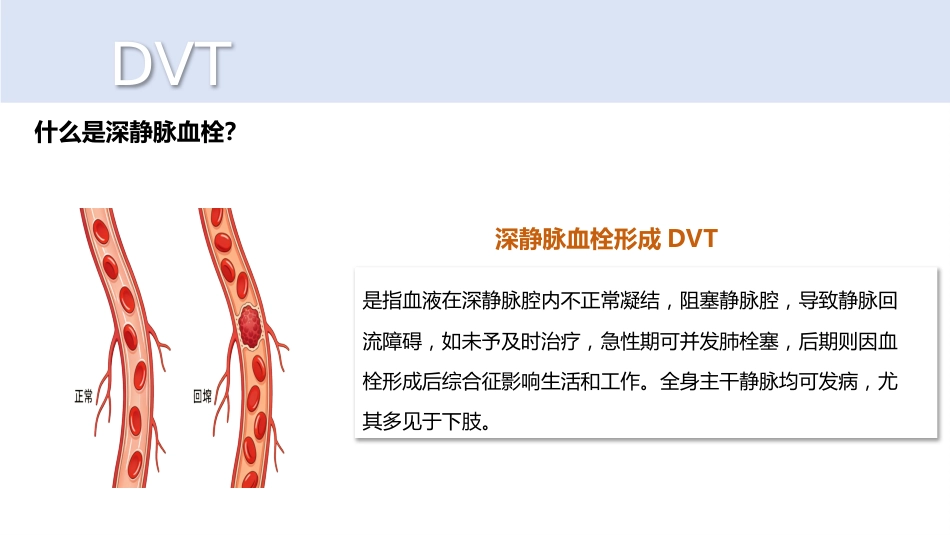 深静脉血栓_第4页