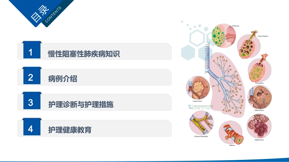 慢性阻塞性肺病护理查房_第2页