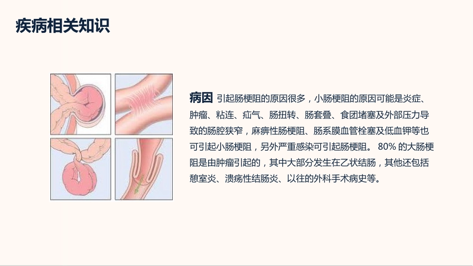 内科护理：肠梗阻护理查房_第5页