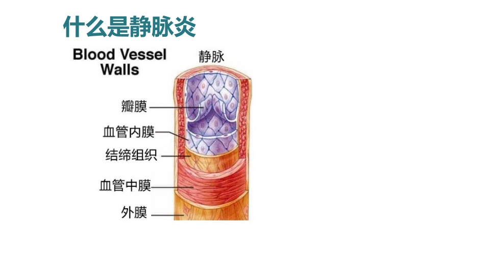 静脉炎的预防及护理ppt_第5页