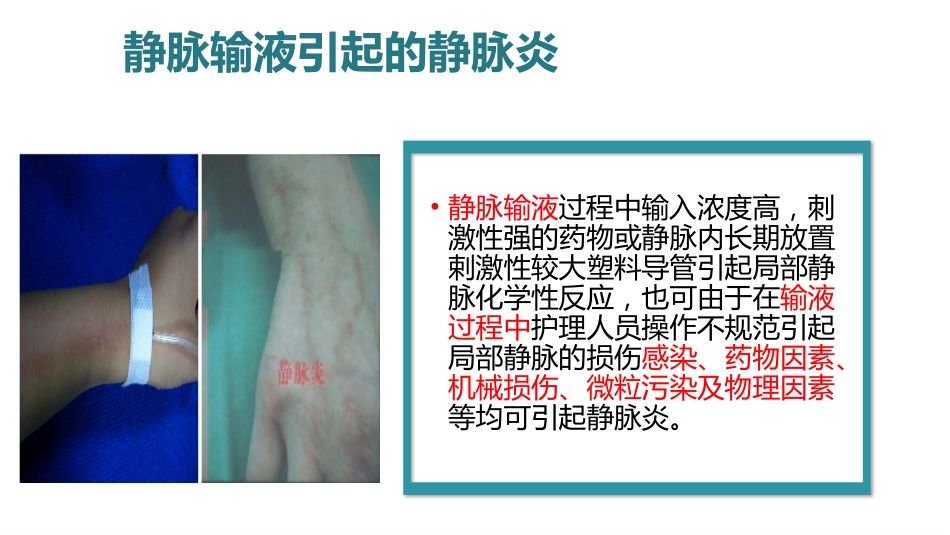 静脉炎的预防及护理ppt_第6页