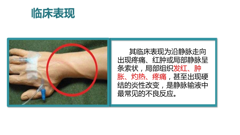 静脉炎的预防及护理ppt_第8页