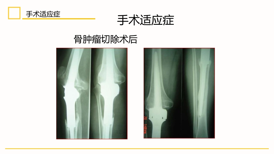 外科护理：膝关节置换术后护理_第13页