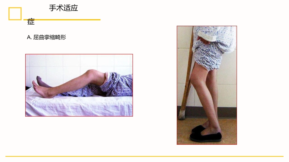 外科护理：膝关节置换术后护理_第4页