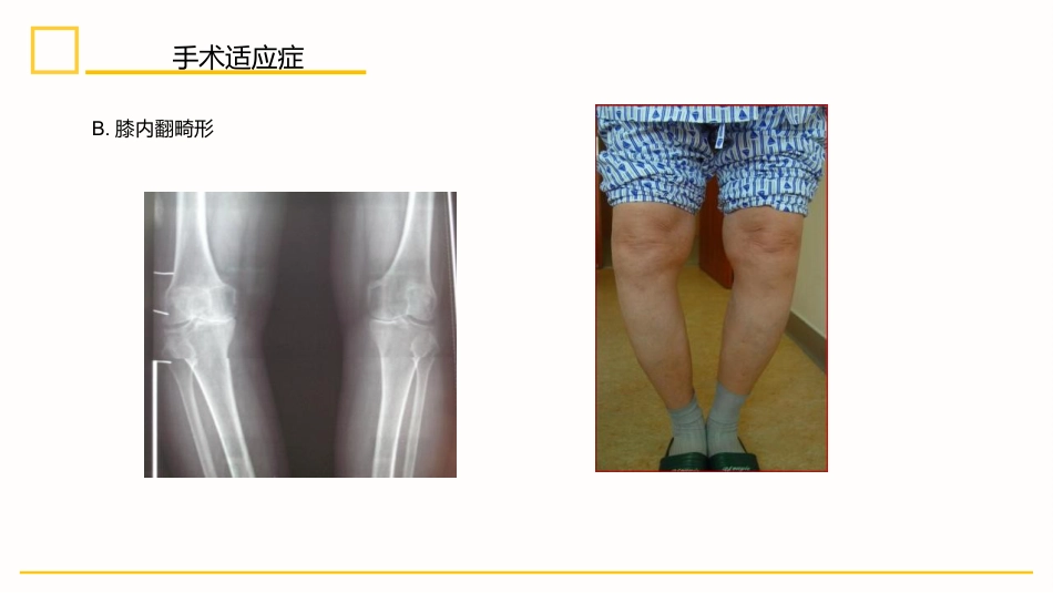 外科护理：膝关节置换术后护理_第5页