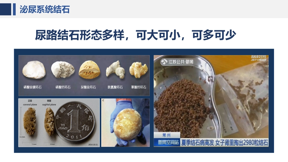 经皮肾镜碎石术后护理课件_第5页