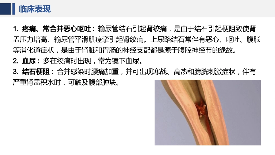 经皮肾镜碎石术后护理课件_第8页