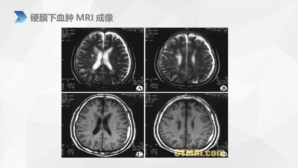 外科护理：亚急性硬膜下血肿护理查房_第13页