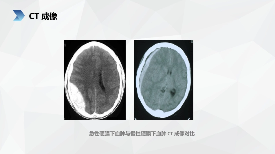 外科护理：亚急性硬膜下血肿护理查房_第15页