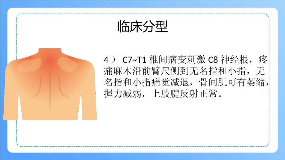 外科护理：颈椎病病人的护理_第11页