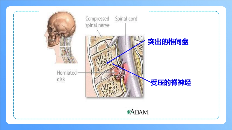 外科护理：颈椎病病人的护理_第14页